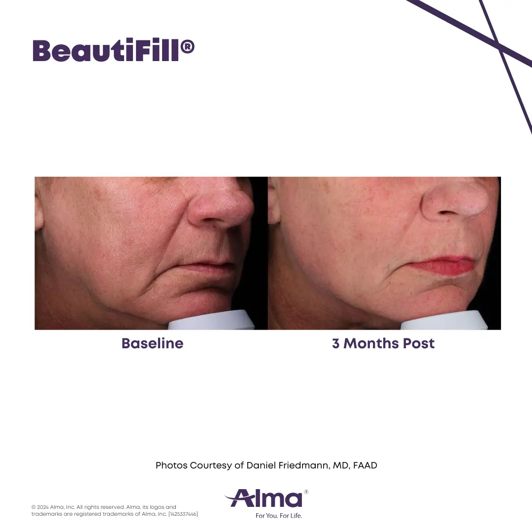 Liquid Facelift before and after