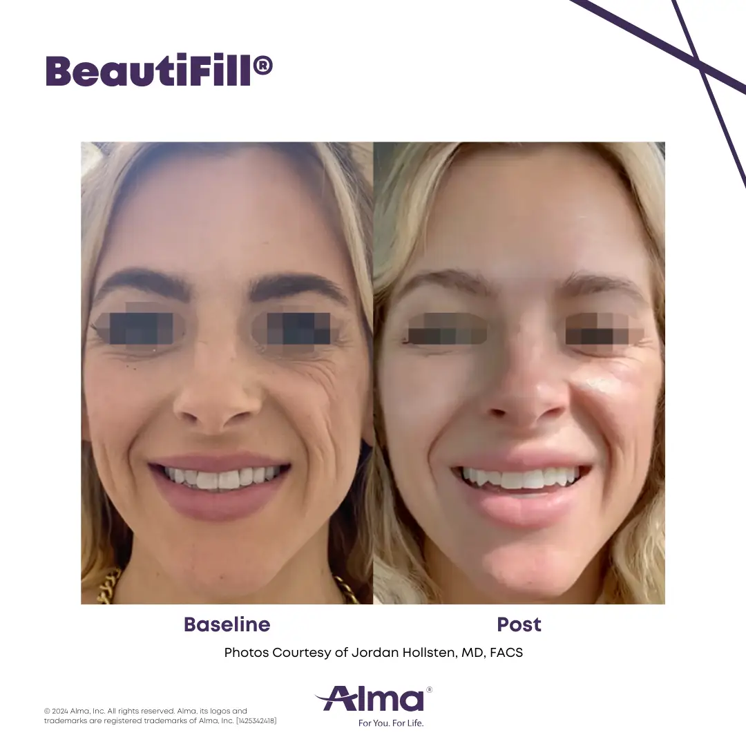 Liquid Facelift before and after