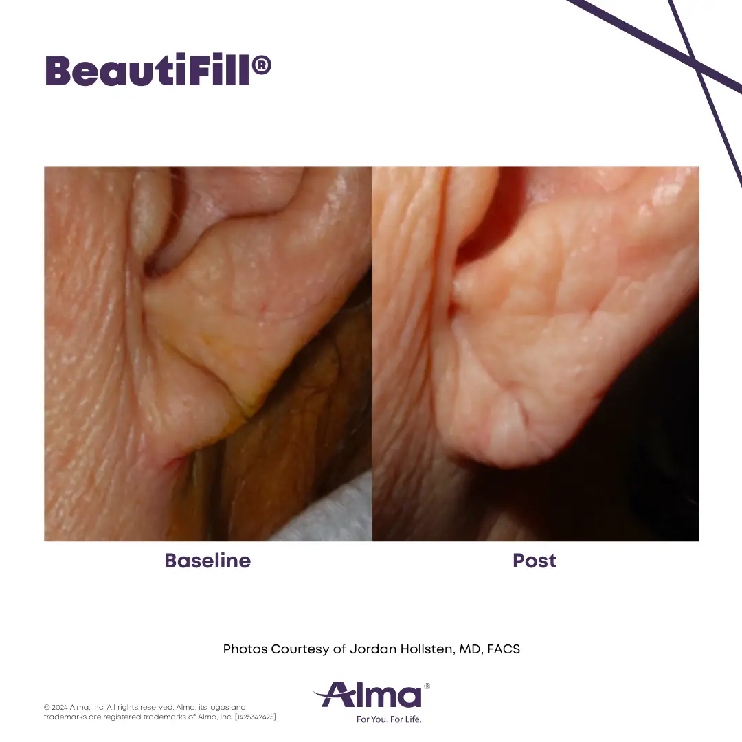 Liquid Facelift before and after