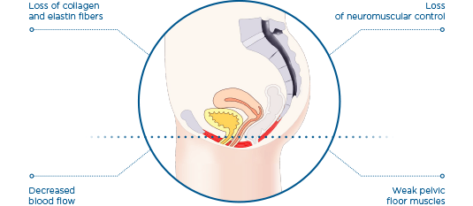 How the Emsella incontinence treatment works