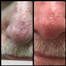 LED photofacial in Ponte Vedra