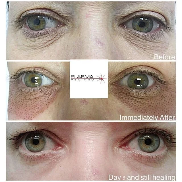 Fractional Pen treatment in Ponte Vedra