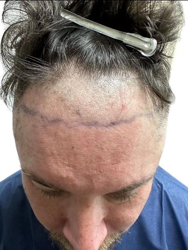 FUE hair transplant before photo at Laser Loft